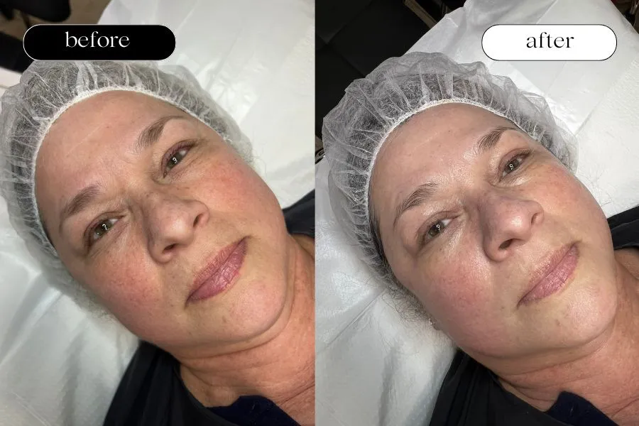 Resultado Facial Anti-Edad